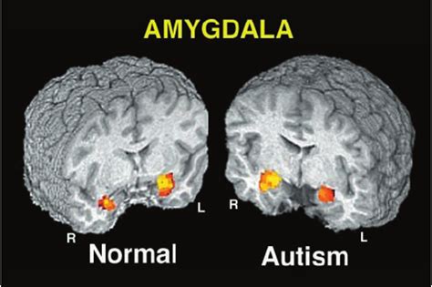 Anxiety, the Amygdala, and Autism | IMUTISM