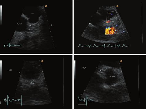 Transthoracic Echocardiogram Complete