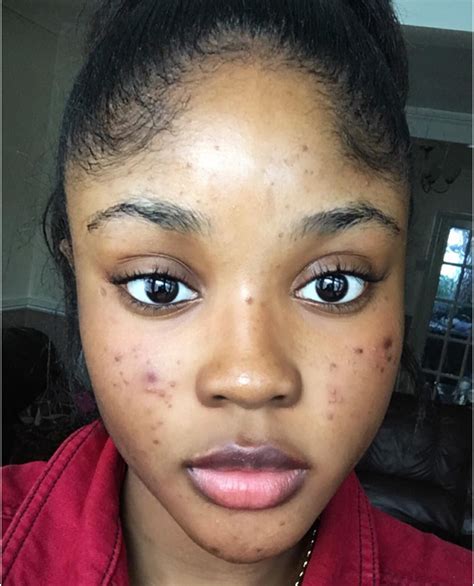 6 Bloggers Talk To Teen Vogue About Their Acne Journeys | Teen Vogue