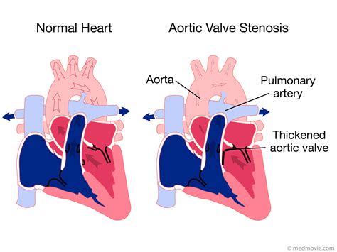 Aortic Valve Stenosis