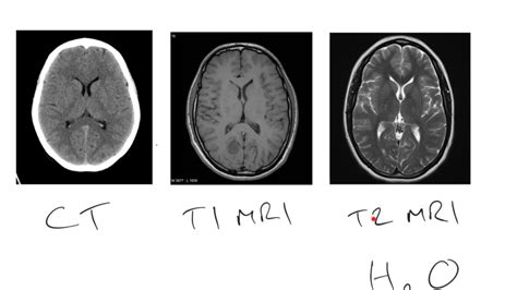 Mri Vs Ct Brain