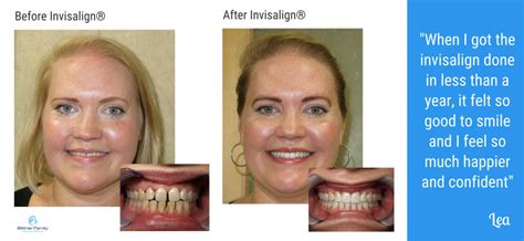 Invisalign® Before & After Pictures – Bittner Family Dental Group San Jose California