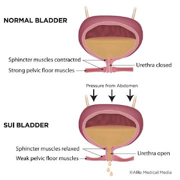 Stress Urinary Incontinence? Pelvic Floor Physiotherapy can Help ...