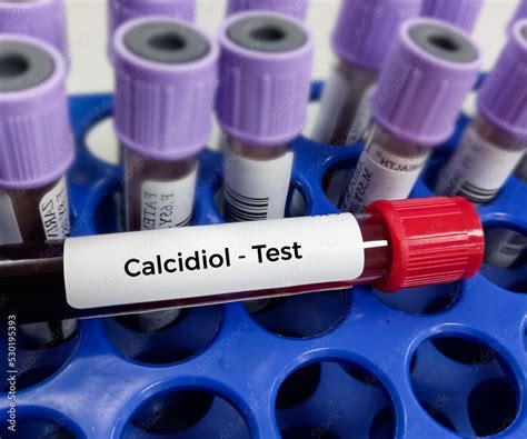 Blood sample for Calcidiol blood test, also known as the 25-OH vitamin ...