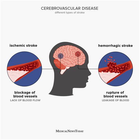 Cerebrovascular disease: Causes, symptoms, and treatment