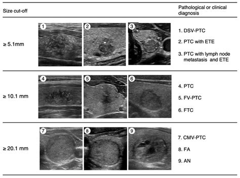 Thyroid Adenoma Ultrasound Appearance