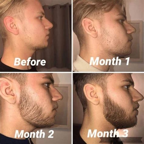 Beard Roller: Activate New Growth (Microneedle) - Bald & Beards