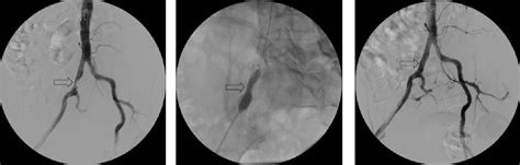 Iliac Artery Angioplasty and Stenting - Vascular Centre