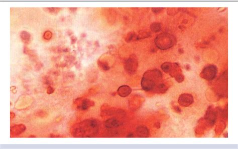 [PDF] Detection of calcium phosphate crystals in the joint fluid of patients with osteoarthritis ...