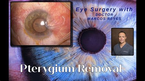 Pterygium Removal Surgery - YouTube