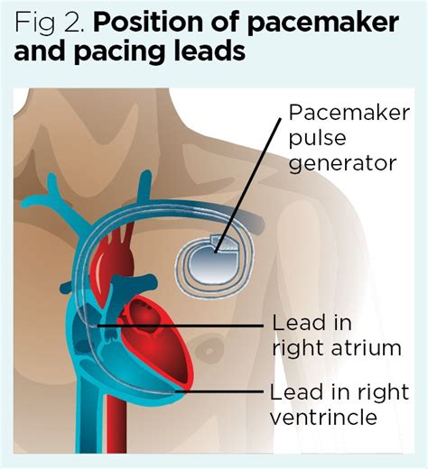 Describe the Function of the Pacemaker