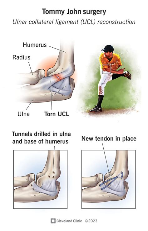 Tommy John Surgery: Details & Recovery Time