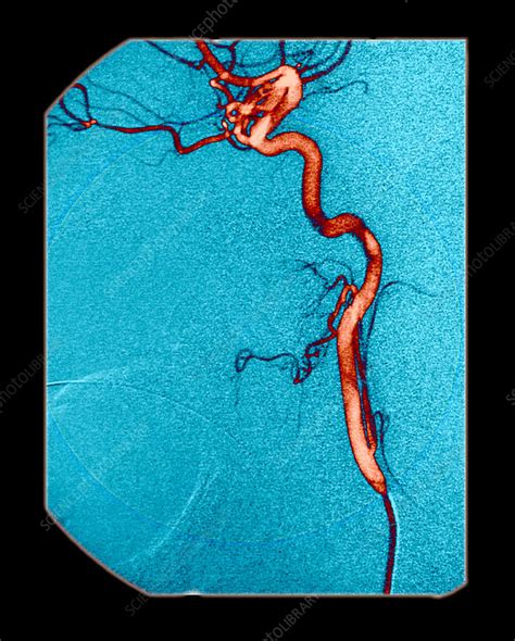 Internal Carotid Artery, Angiogram - Stock Image - C007/5815 - Science Photo Library