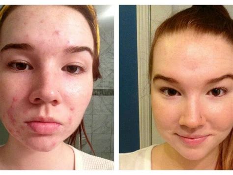 Skin Tag & Acne Patch | An Absolute Review - Cheaperks