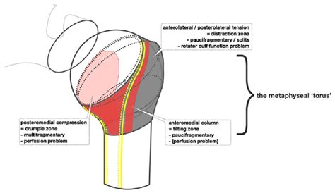 Diagram to illustrate the concept of the metaphyseal torus. | Download Scientific Diagram