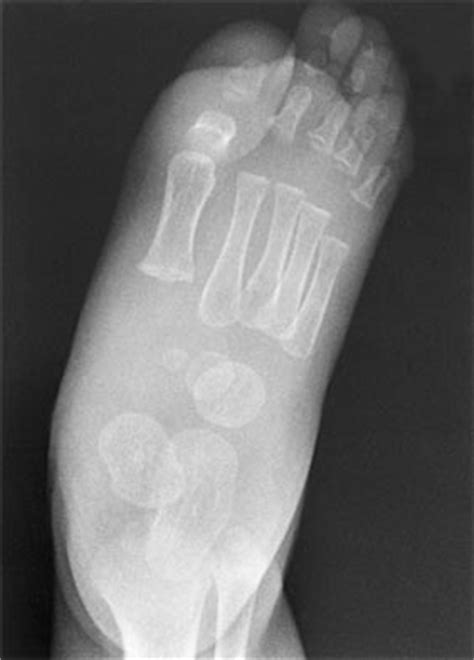 Congenital Vertical Talus - Pediatrics - Orthobullets