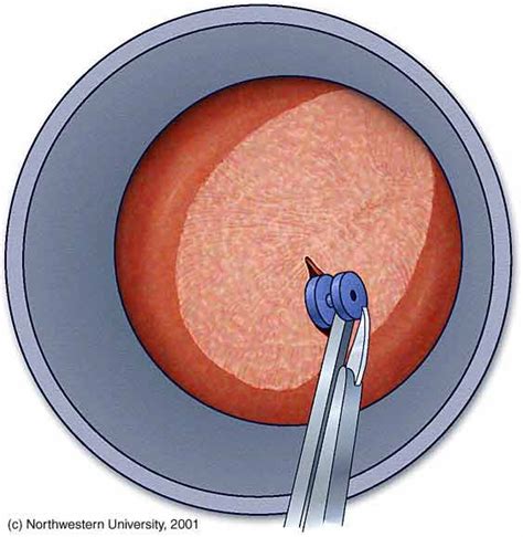 ear drum perforation