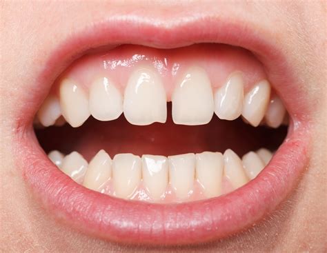 Options to close a diastema | City Dentists Wellington