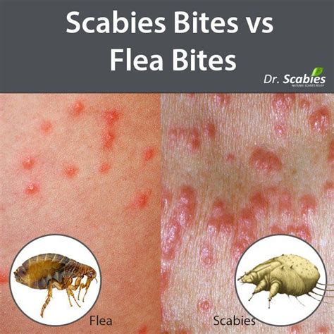 Flea Bites Vs Bed Bug Bites 1 | Bed bug bites, Psoriasis treatment, Bed bug bites pictures