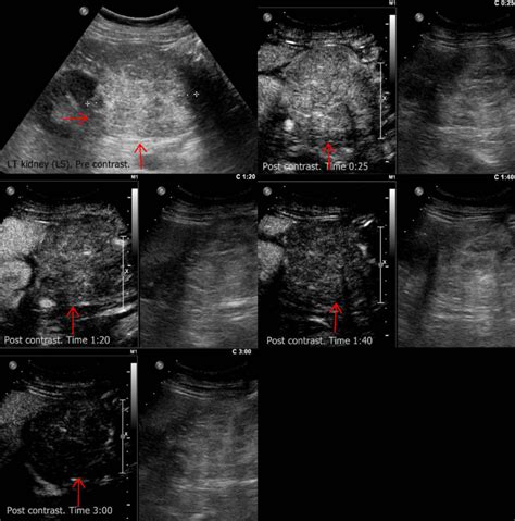 Renal angiomyolipoma in an 8-year-old boy, with incidental note of a... | Download Scientific ...