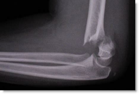 Ulna Elbow Fracture