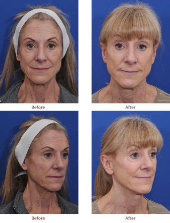 LIFE Before and After Photos | Mini-Facelift