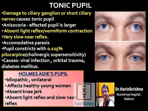 Tonic Pupil - EyeToday