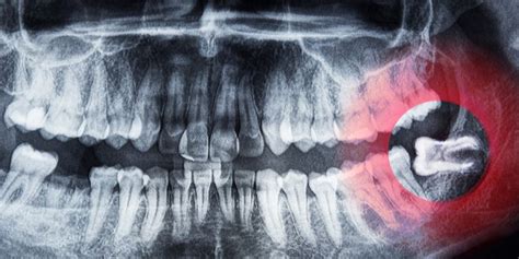 What Is Wisdom Teeth Removal: Everything You Need To Know | Peel Dental Studio Dentist Mandurah