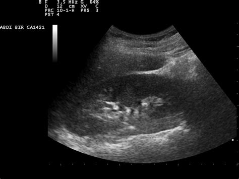 Ultrasound procedure for kidney stones | Urinary Tract Issues articles | Body & Health ...