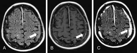 Patient with clinical history of trauma and subdural hematoma. A, Axial ...