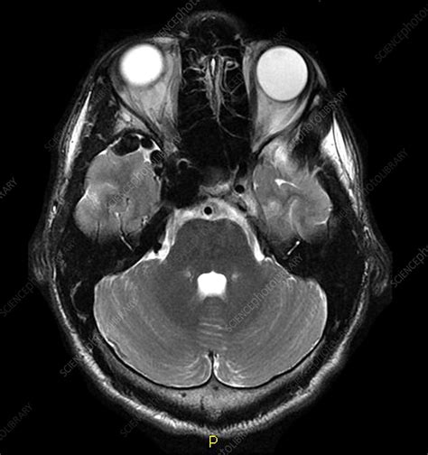 Carotid Cavernous Sinus Fistula, MRI - Stock Image - C027/1832 - Science Photo Library