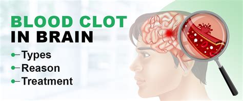 Blood Clot in Brain: Types, Reason & Treatment