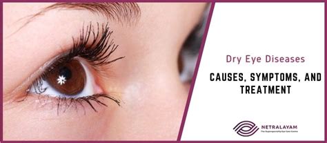 Dry Eye Diseases: Causes, Symptoms, and Treatment