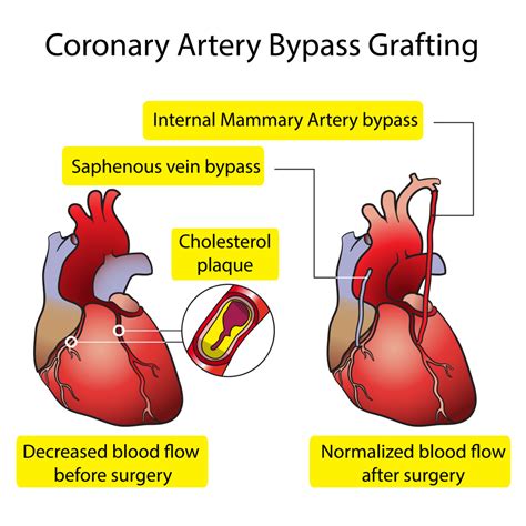 Coronary Artery Bypass Grafting (CABG) - Simplified - Heart Sense