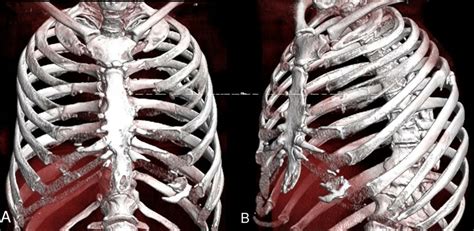 Chronic pain associated with costal margin rupture | Trauma Surgery & Acute Care Open