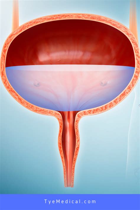 Overflow Incontinence Treatment: What to Do About This Common Male Bladder Condition - TYE Medical