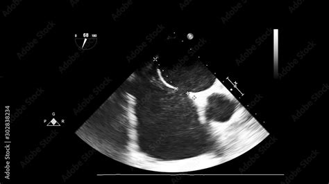 Screen of echocardiography (ultrasound) machine. Stock Photo | Adobe Stock