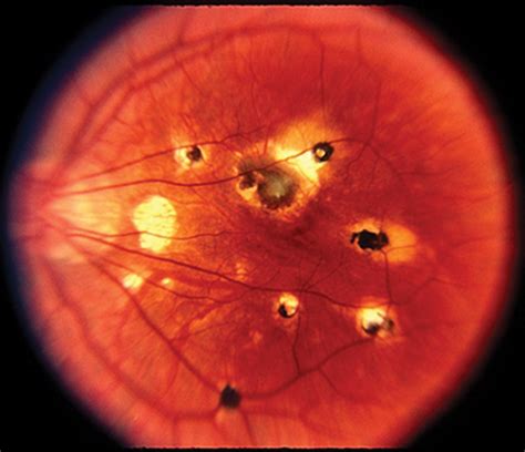 White dot syndromes | Eye News