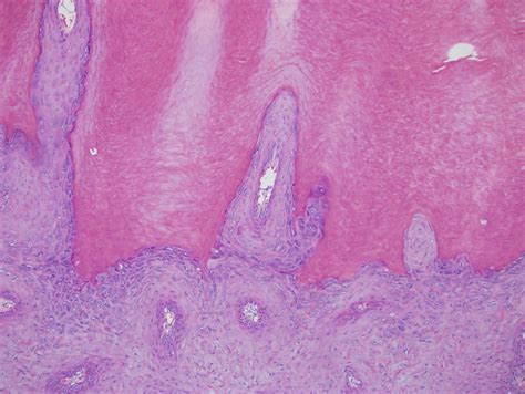 Pathology Outlines - Cutaneous horn