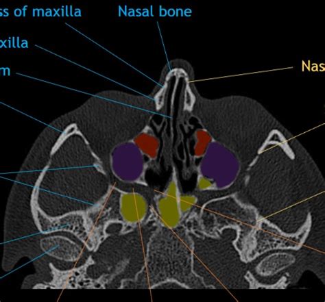 CaseStacks.com - Face CT Anatomy