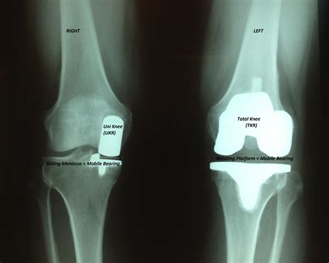 Advances in Knee Replacement - Scottsdale Joint Center