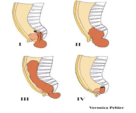 Types of sacrococcygeal teratoma | Download Scientific Diagram