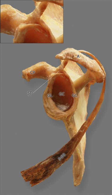 Type I of the long head of the biceps brachii. CP coracoid process A... | Download Scientific ...