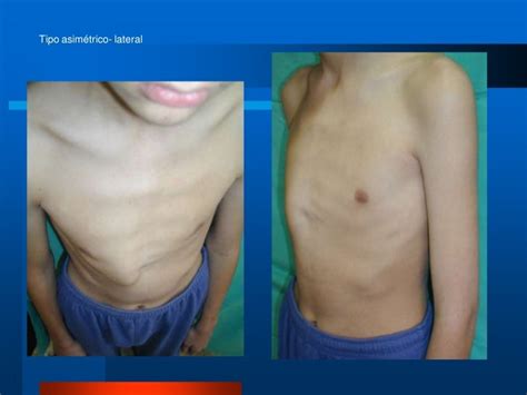 Pectus Excavatum Vs Pectus Carinatum