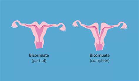 Bicornuate Uterus: Symptoms, Treatment, and Its Impact