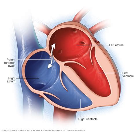 Patent foramen ovale - Mayo Clinic