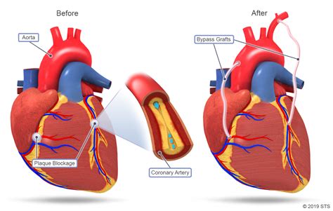 Coronary Artery Bypass Grafting (CABG) | The Patient Guide to Heart ...