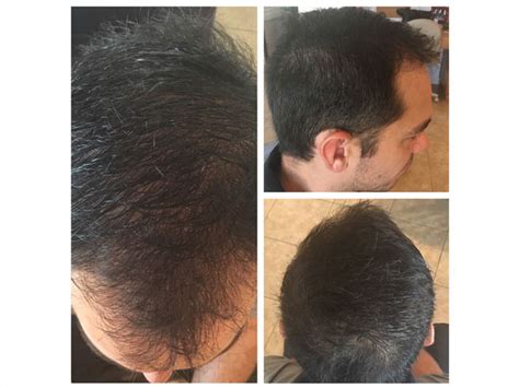 PRP Hair Restoration | PRP Hair Restoration Near Me | Read Our Reviews