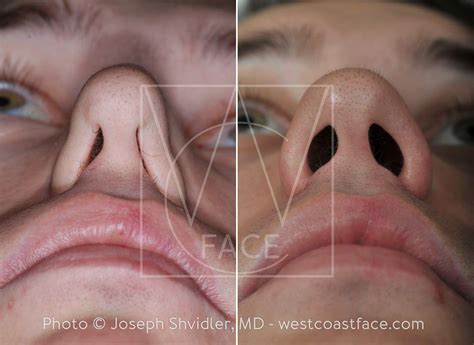 Nasal Valve Collapse - West Coast Face