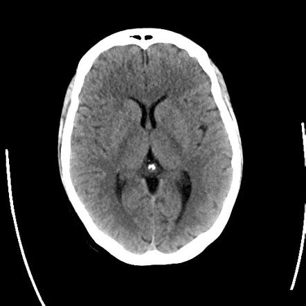 Playlist 'UQ Radiology 'how to' series: Brain: Introduction' by Assoc ...